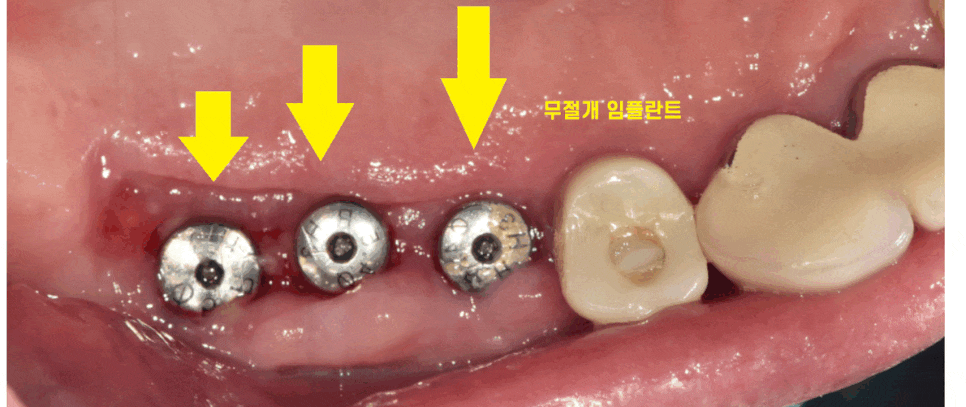 천호동 치과 무절개 임플란트 비교하고 결정하세요 관련 이미지 1