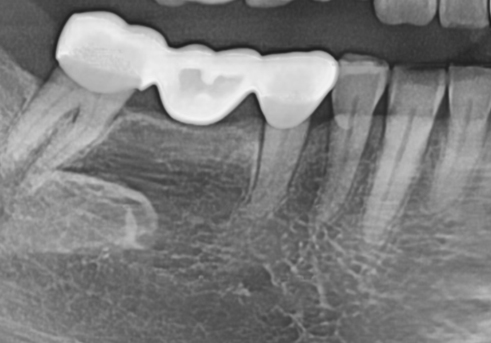 고덕동 스케일링 미루다 앞니 어금니 다 뽑고 임플란트 했습니다. 관련 이미지 11