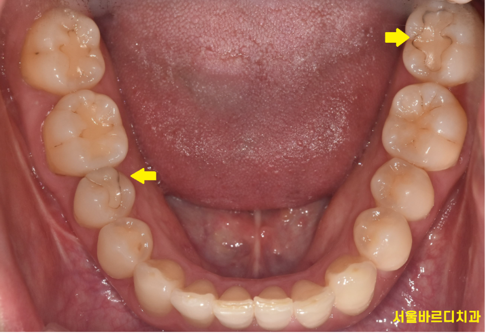 하이브리드 인레이 치아 사이 충치 치료할 때 사용됩니다. 관련 이미지 4