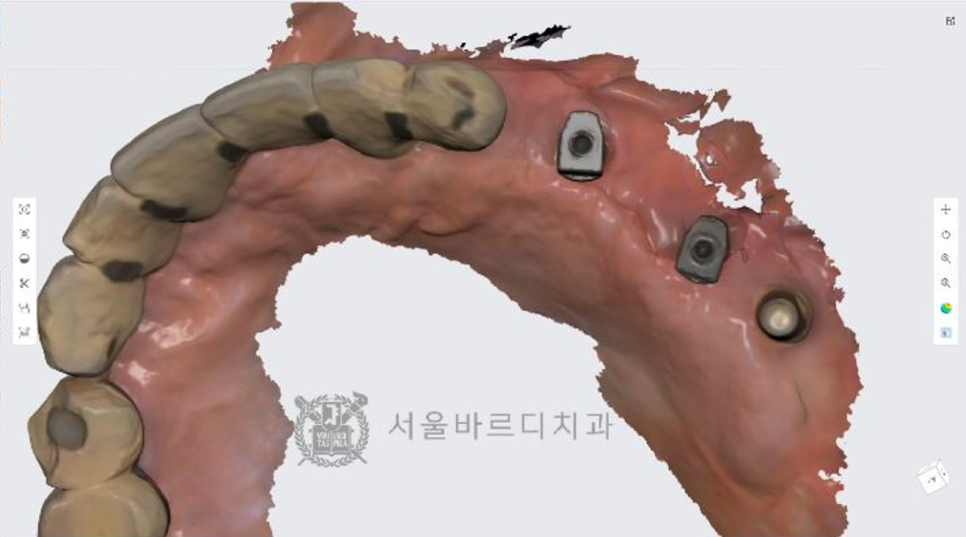 상일동역치과 서울바르디치과 무절개 네비게이션 임플란트 치료증례 #5 관련 이미지 15