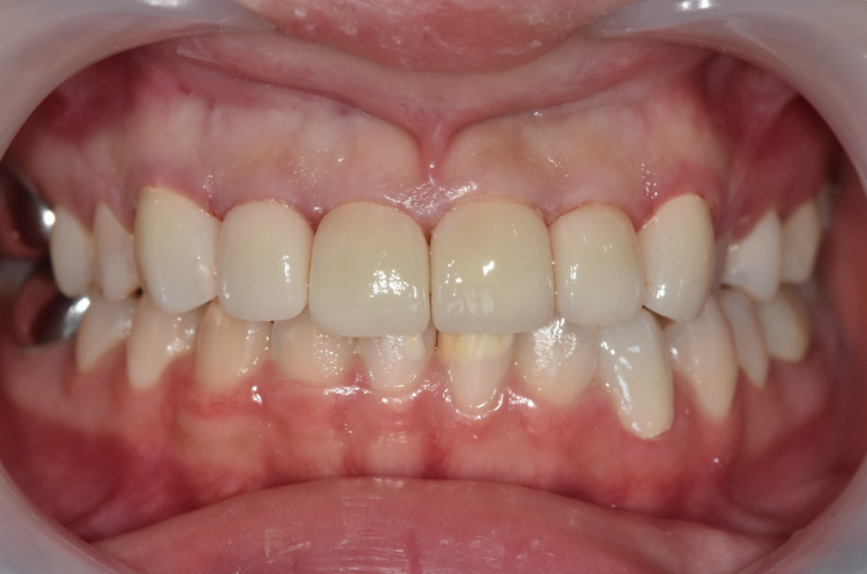 강동구 라미네이트, 치아 하얀 반점 없애고 싶다면? 치료 방법 관련 이미지 15