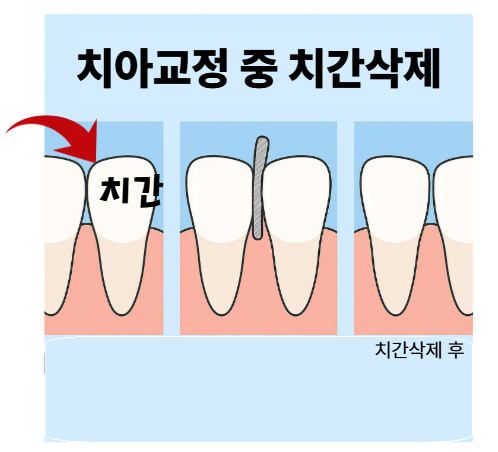 Are There Any Side Effects of Interproximal Reduction During Orthodontic Treatment? Click Here If You’re Concerned image 1