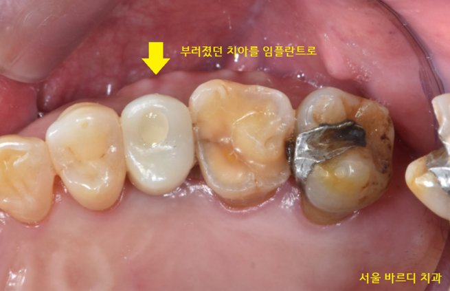강일동 치과 치아 부러짐 붙일 수 있을까요?? 관련 이미지 10