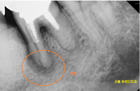 고덕역 치과 치아뿌리 파절 부러짐 있을 때 임플란트로 대체해야죠 관련 이미지 4