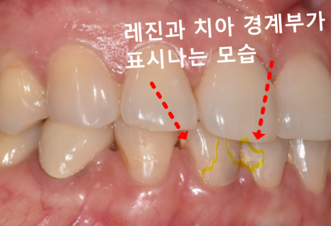앞니 레진 떨어짐, 자꾸 반복된다면 관련 이미지 4