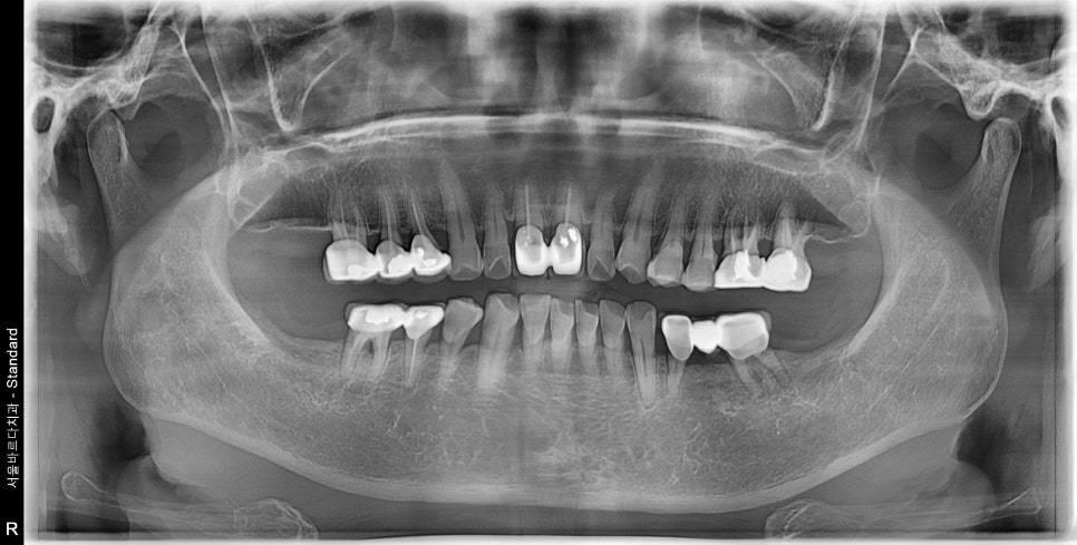 Godok Implant: Treatment That Reduced the Financial Burden with Insurance Implants for a Patient in Their 70s image 1