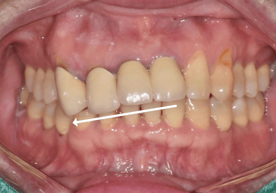 고덕동 심미 보철, 삐뚤어진 앞니, 교정 없이 바로잡은 비결 관련 이미지 3