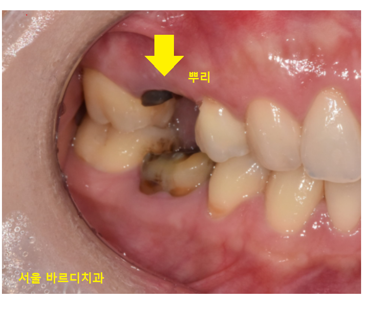 풍산동 치과 임플란트 양쪽 치료 가능한가요? 관련 이미지 5