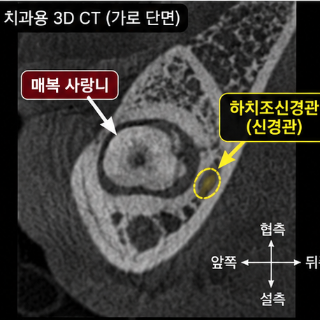 자꾸 볼을 씹는다면, 사랑니 원인일 수 있습니다. 볼씹힘 관련 이미지 6
