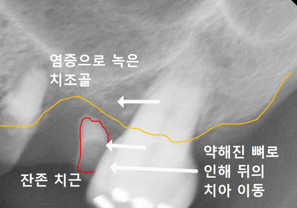 뿌리만 남은 치아, 그대로 두면 왜 위험할까요? 고덕동 전체 임플란트 재건 사례 관련 이미지 2