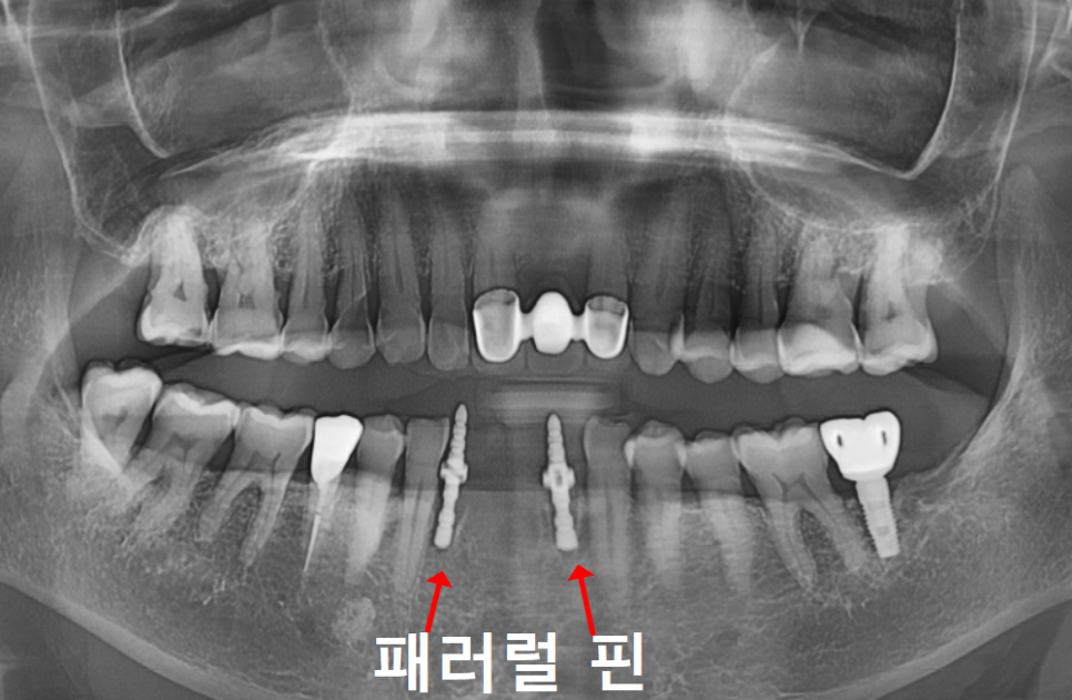 솟구치는 앞니, 흔들리는 치아가 보내는 관련 이미지 10