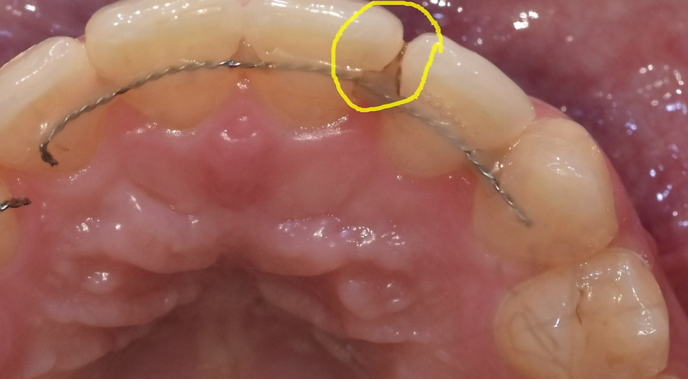 상일동역 치아교정 부작용 꼭 알아보고 대처하세요!!! 관련 이미지 5