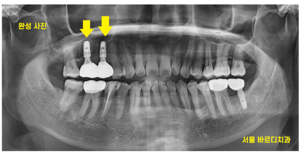 풍산동 치과 임플란트 음식물 끼임 원인과 해결방법은?? 관련 이미지 5