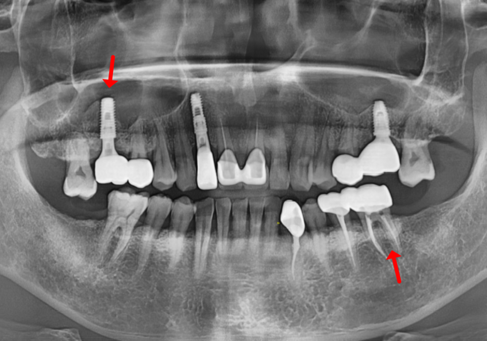 상일역 치과, 오래된 금니 빠짐, 같은 증상으로 내원했지만 전혀 다른 결과, 그 차이는? 관련 이미지 17