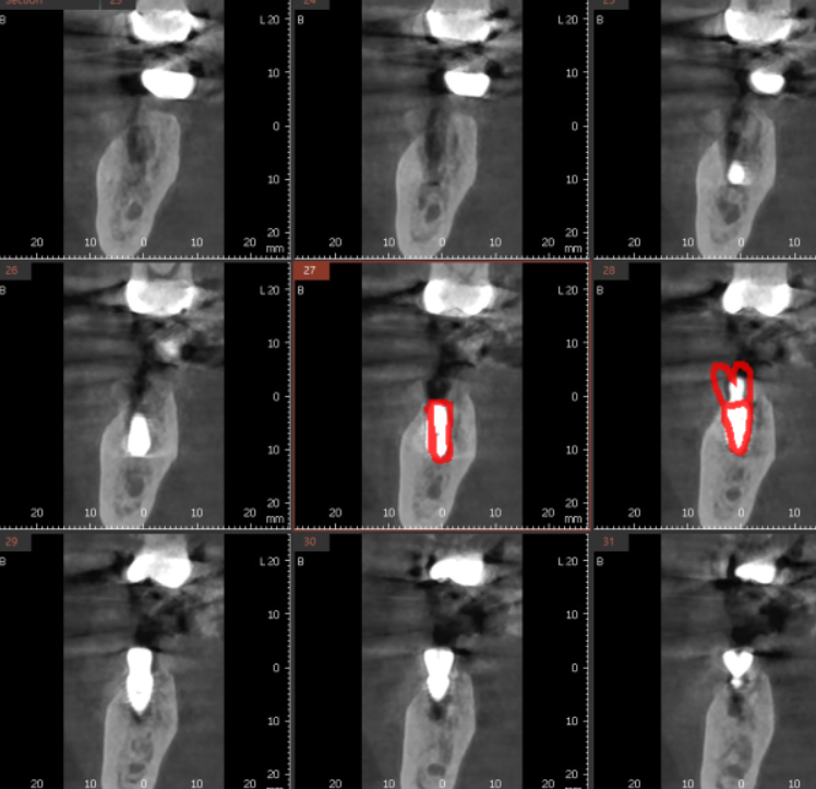 잇몸 물집 강일역 치과에서 원인 알아보고 임플란트로 치료했습니다. 관련 이미지 9