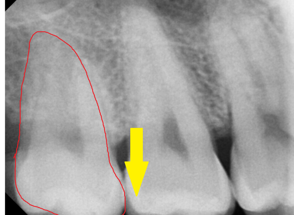 상일동 사랑니 발치  시간, 비용 절약하는 3가지 꿀팁 공개~! 관련 이미지 5