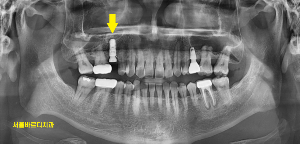 풍산동 치과 어금니 쪼개짐 임플란트를 해야할 때는? 관련 이미지 8