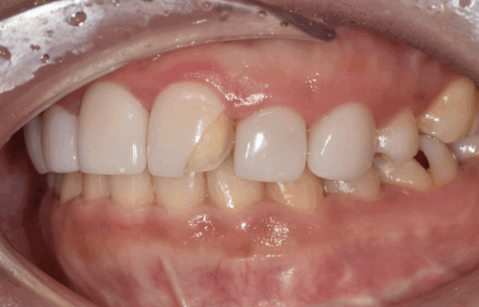 라미네이트 깨짐 원인 TOP 3, <대표원장>이 직접 알려드립니다 관련 이미지 3