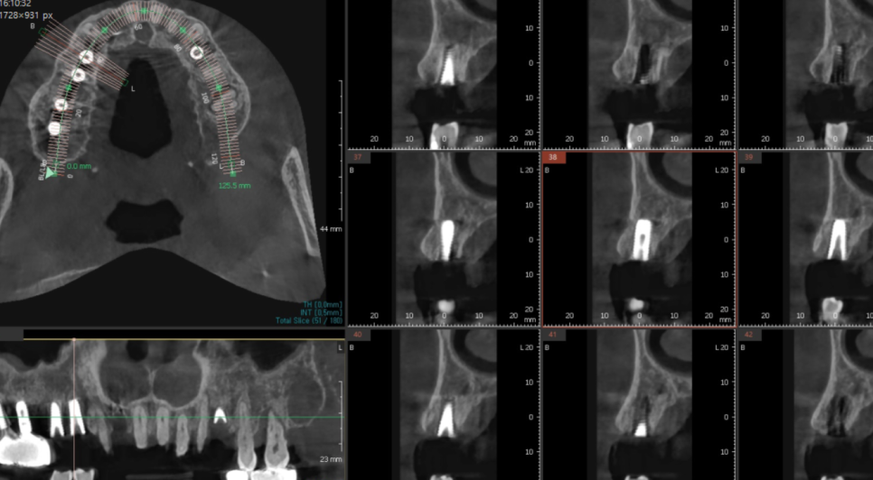 강일동 임플란트 위아래 치아 흔들림과 통증이 있을 때 방법은? 관련 이미지 8