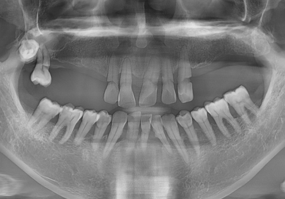 위 턱 전체 임플란트 vs 부분 틀니, 나에게 꼭 필요한 치료법 찾기 관련 이미지 2