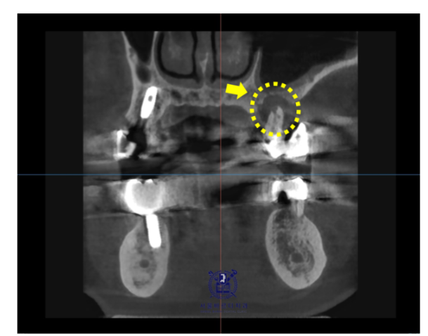 강동구 임플란트 수술 전 확인하면 좋을 3가지 관련 이미지 4