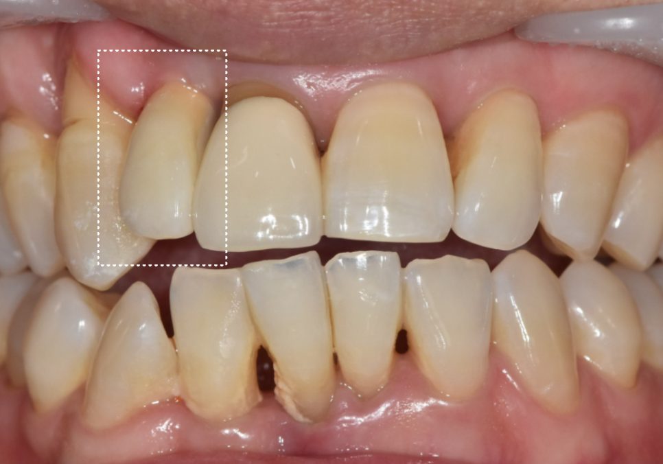 앞니 임플란트, 원내 기공소의 중요성을 아시나요? 관련 이미지 10