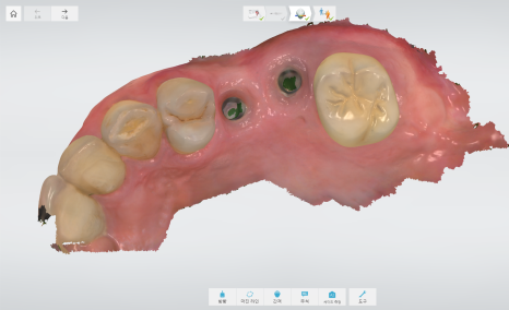 상일동 임플란트 상악동 거상술을 동반한 수술 증례 관련 이미지 14