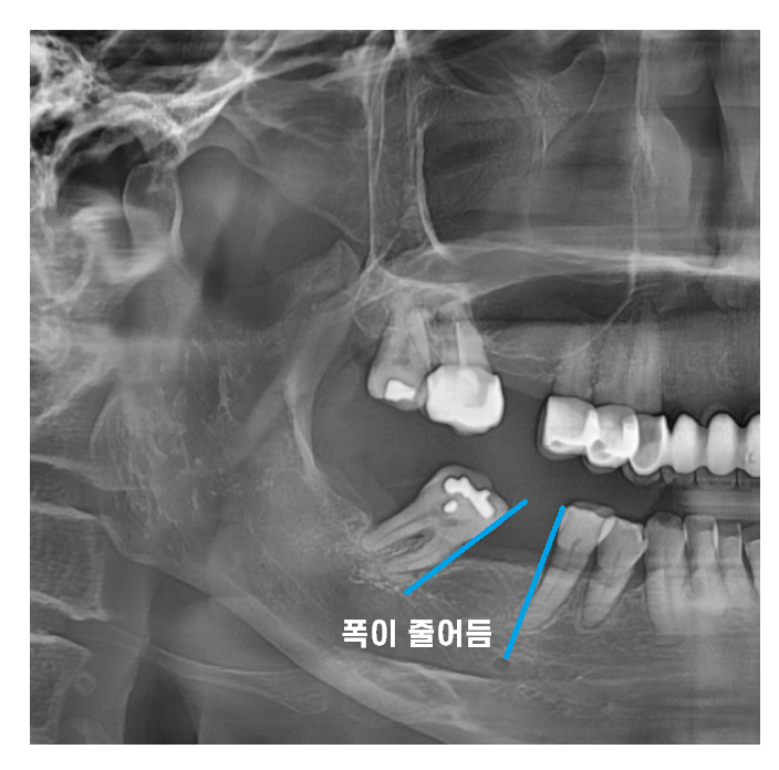 고덕역 치과 빠진 어금니 방치 그대로 두다가는 임플란트가..? 관련 이미지 5
