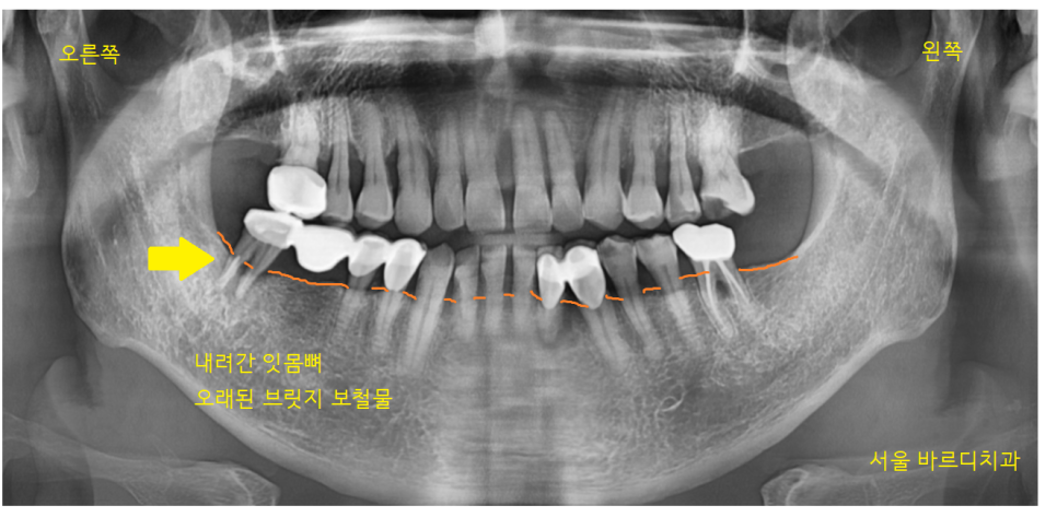 오래된 브릿지 보철 제거 후 고덕역 임플란트 교체 케이스 관련 이미지 2