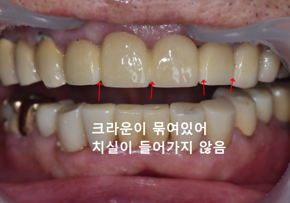 앞니 음식물 끼임, 왜 젊을 때보다 더 자주 발생하는 걸까요? 까맣게 변한 앞니 치료 사례 관련 이미지 10