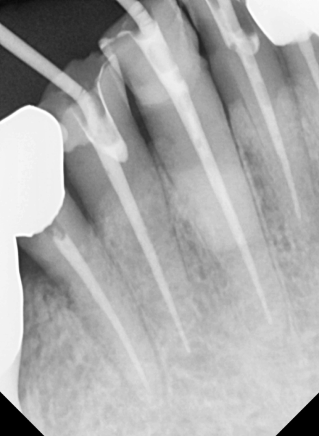 앞니 음식물 끼임, 왜 젊을 때보다 더 자주 발생하는 걸까요? 까맣게 변한 앞니 치료 사례 관련 이미지 14