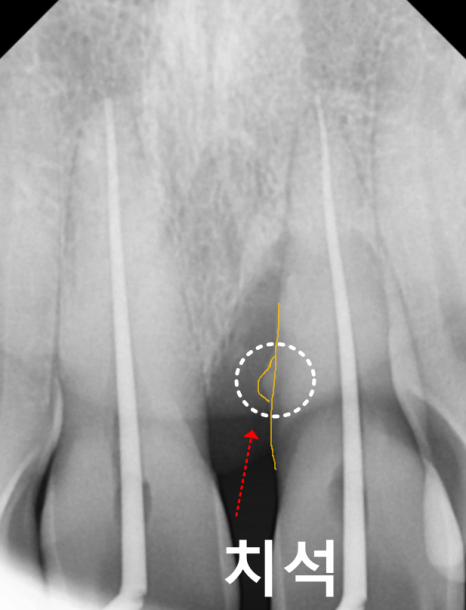 잇몸 내려감으로 길어진 치아, 방치하면 안 되는 원인, 증상, 이유 관련 이미지 8