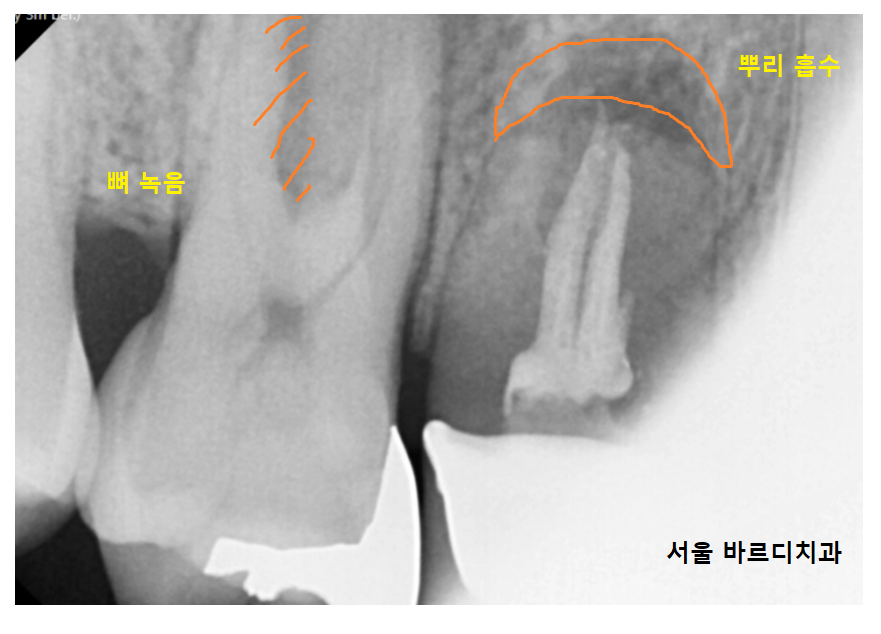 고덕역 임플란트 잇몸 뾰루지 뼈이식 두번 하여 해결했습니다. 관련 이미지 4