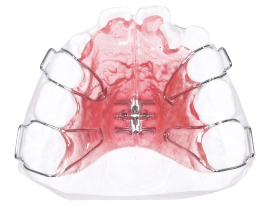 소아 악궁확장 RPE장치란? 성장기 1차 교정 진행해야할 때 관련 이미지 4