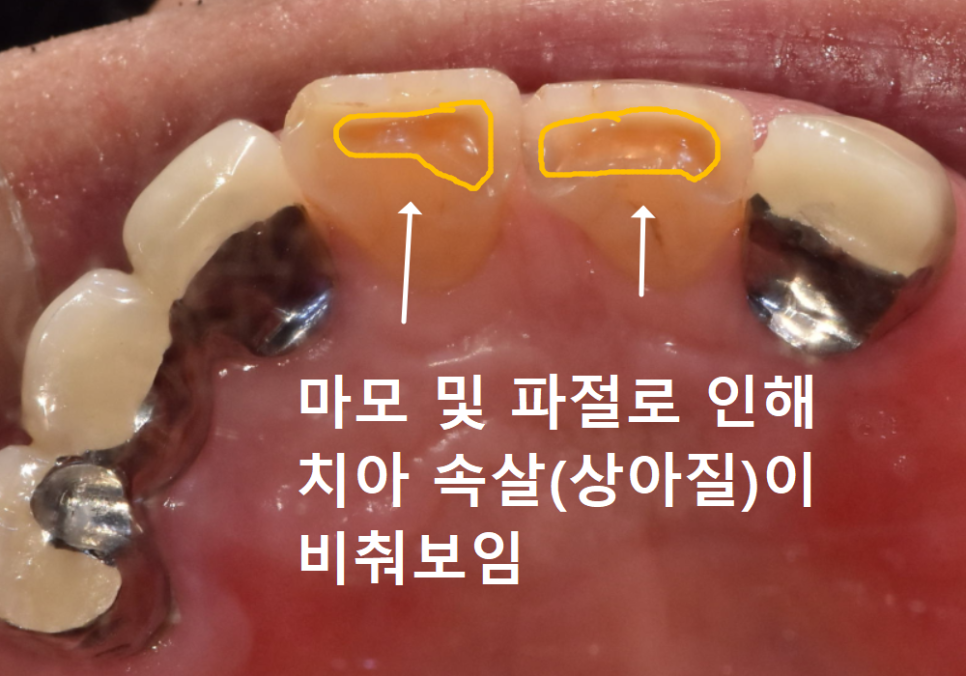 Godeok-dong Tooth Fracture: Check This Before Getting an Implant! Revealing the Criteria for Saving It image 4