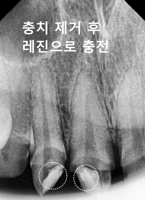 A Single Black Spot of Decay Between the Front Teeth May Be a Warning Sign of Multiple Cavities. image 7