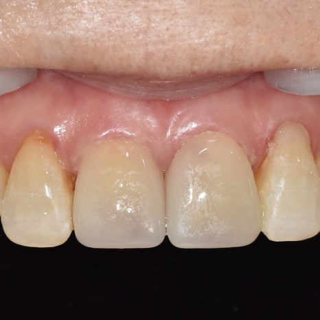 No-Prep Veneers: Do They Really Involve No Tooth Shaving? The 3 Questions Patients Ask Most image 6