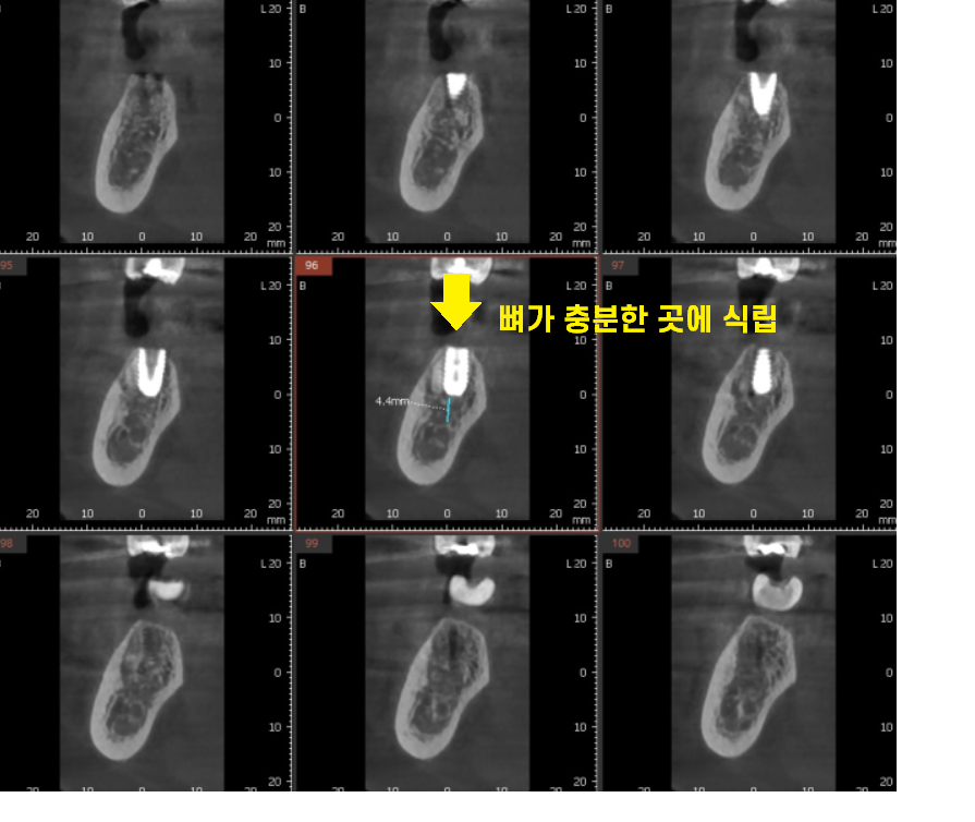 풍산동 치과 아래 어금니 임플란트 뼈 이식 없이 해결했습니다. 관련 이미지 5