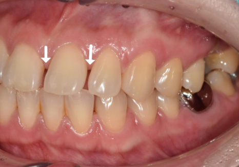 무삭제 라미네이트 적응증, 당신이 미처 몰랐던 시술의 조건을 공개합니다. 관련 이미지 9