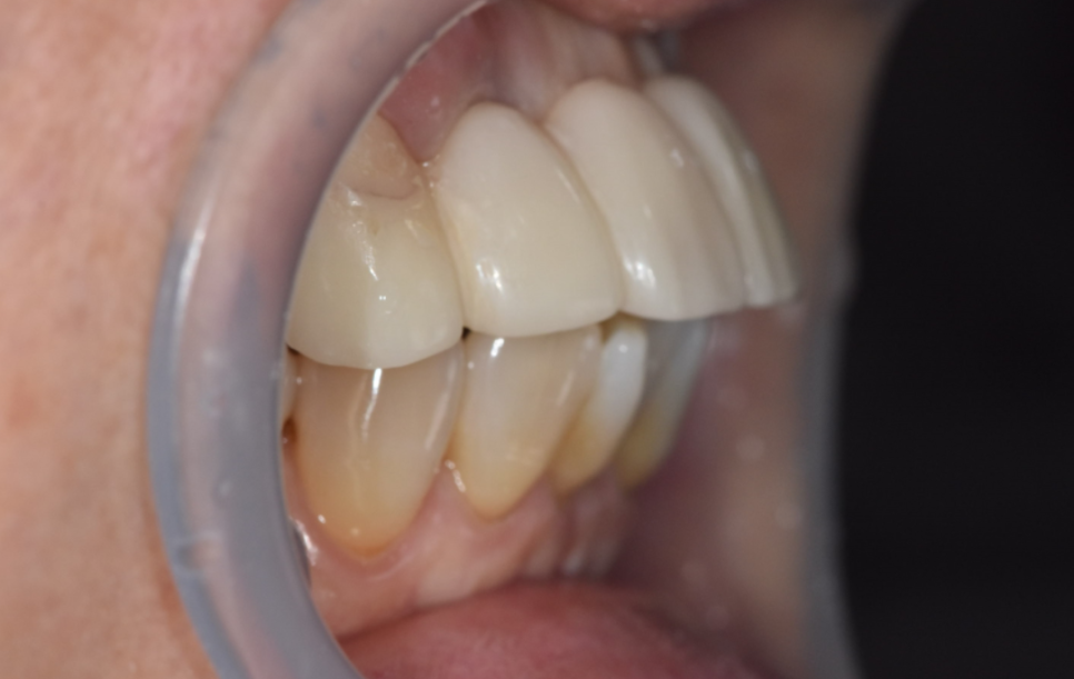 명일동 앞니 브릿지, 새로 교체 할 때 꼭 확인해 봐야 할 관련 이미지 10