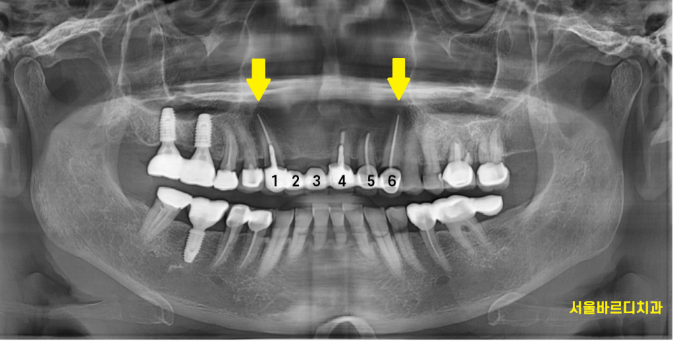 하남미사치과 앞니 브릿지를 임플란트로 교체했습니다. 관련 이미지 2