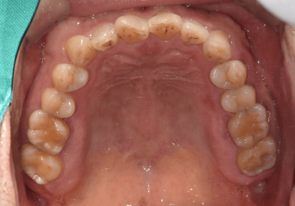 앞니 깨짐 치료 비용, 더이상 치과에 돈 낭비하기 싫다면? 깨지는 원인부터 알아야 합니다. 관련 이미지 3