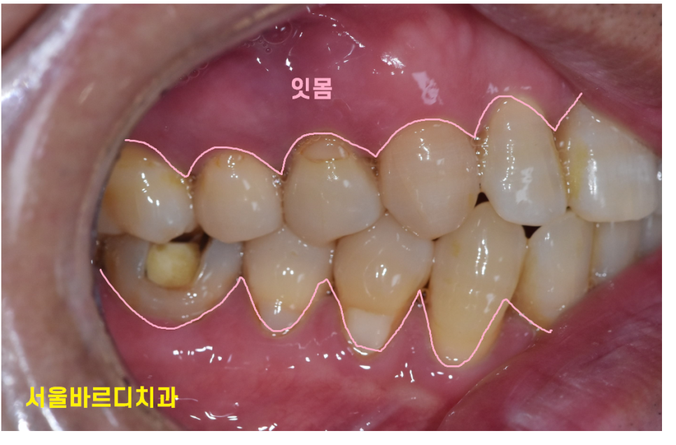 상일동역 치과 잇몸 뼈 녹음 임플란트 케이스 관련 이미지 2