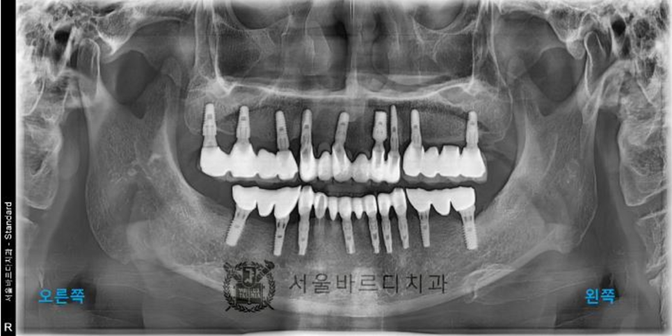 상일동역치과 서울바르디치과 무절개 네비게이션 임플란트 치료증례 #5 관련 이미지 1