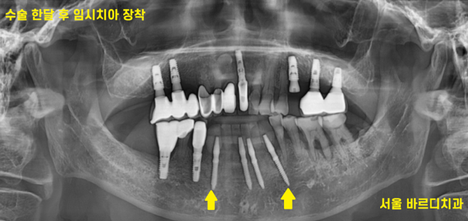 강동구 치과 앞니 흔들림 임플란트 케이스 관련 이미지 6