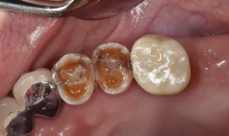 명일동 치과 임플란트 치료 기간 얼마나 걸릴까요??? 관련 이미지 9