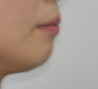 Can Protruding Mouth Be Corrected with Orthodontics Alone, Without Surgery? Sangil-dong Orthodontic Clinic image 1