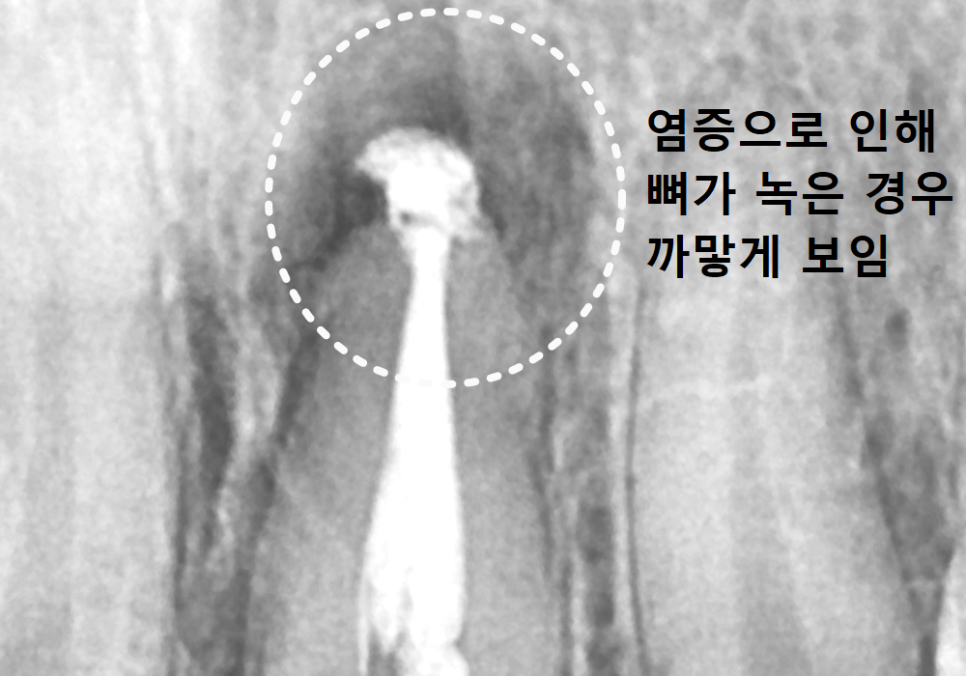 Sangil-dong Station Implant Visits: How Many Times Do You Actually Need to Go to the Dentist? image 2
