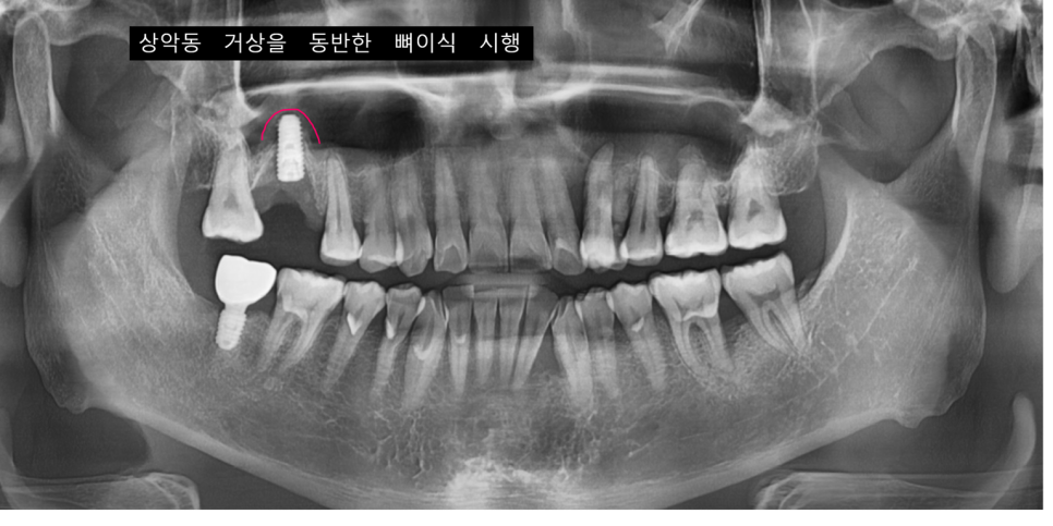 윗니 임플란트 상악동 부위 치아 염증으로 천공되었을 때 수술까지 관련 이미지 8