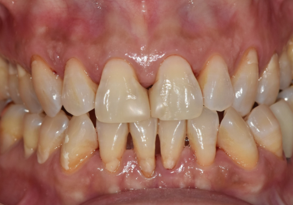 고덕동 치과 누런 이, 앞니 사이 틈, 잘못된 관리 때문일까? 관련 이미지 9